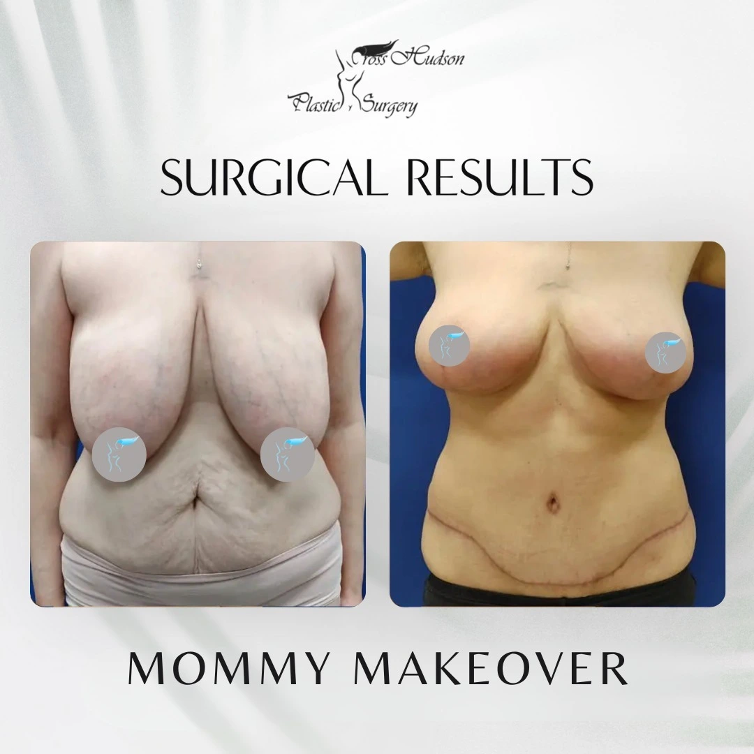 Cross Hudson Plastic Surgery logo and 'Surgical Results' heading for mommy makeover before-and-after comparison showing breast lift and body contouring results